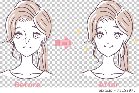 Before and after illustration material of a woman suffering from pore clogging 73152973
