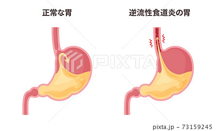 逆流性食道炎の胃と胃酸のイラストのイラスト素材