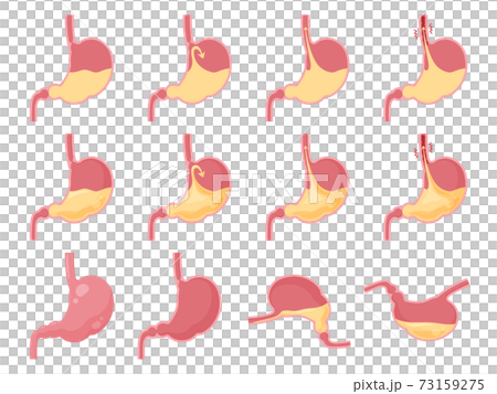 逆流性食道炎の胃と胃酸のイラスト 逆流性食道炎の胃と胃酸のイラスト 73159275