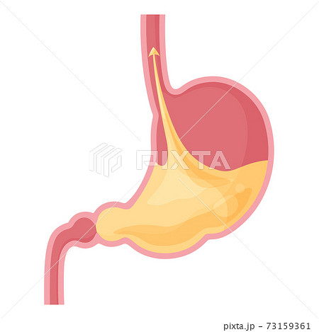 逆流性食道炎の胃と胃酸のイラストのイラスト素材