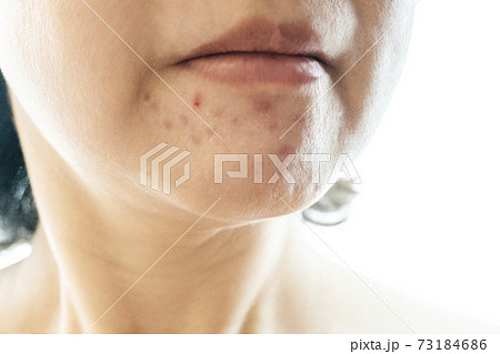 顎のニキビ跡 顎のニキビ跡 73184686