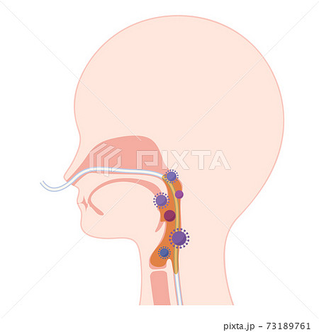 経鼻経管栄養 Ngで痰と細菌が増加した咽頭のイラストのイラスト素材