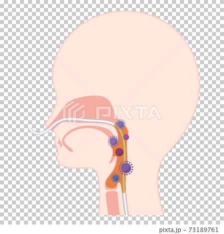 経鼻経管栄養 Ngで痰と細菌が増加した咽頭のイラストのイラスト素材