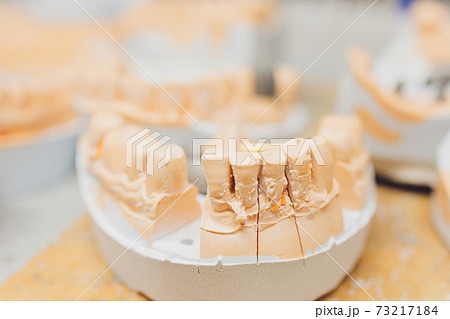 The process of making a dental prosthesis in a dental laboratory. 73217184