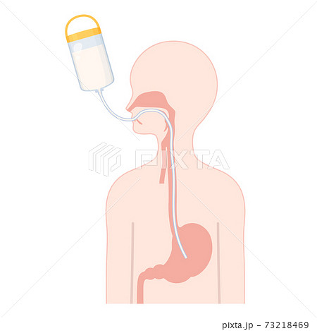 経管栄養_OGの管のイラスト_体の断面 73218469