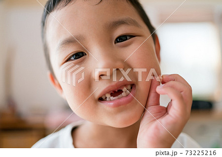 乳歯の生え変わり 乳歯の生え変わり 73225216