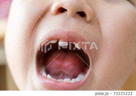 乳歯の生え変わり 73225222