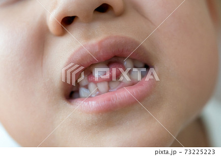 乳歯の生え変わり 73225223