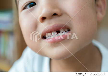 乳歯の生え変わり 乳歯の生え変わり 73225225