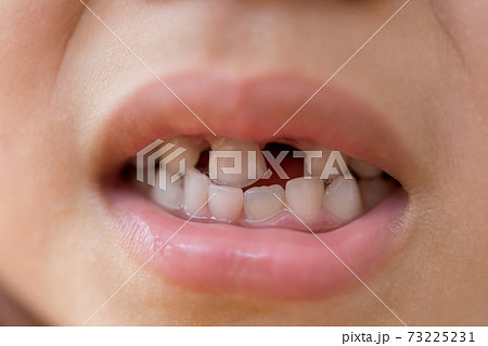 乳歯の生え変わり 乳歯の生え変わり 73225231