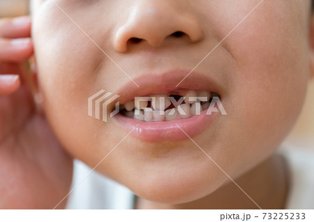 乳歯の生え変わり 乳歯の生え変わり 73225233