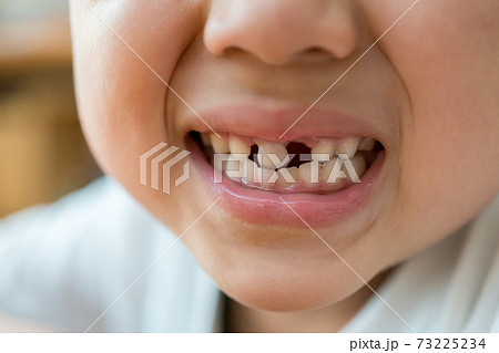 乳歯の生え変わり 乳歯の生え変わり 73225234
