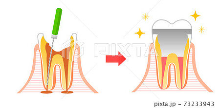 根管治療 虫歯と進行と治療:歯科のイラスト 根管治療 虫歯と進行と治療:歯科のイラスト 73233943