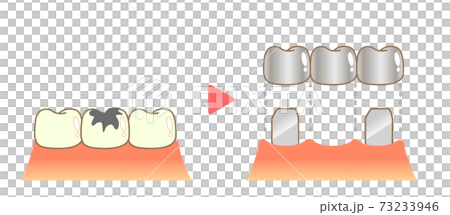 Bridge Caries and Progression and Treatment: Dental Illustration 73233946