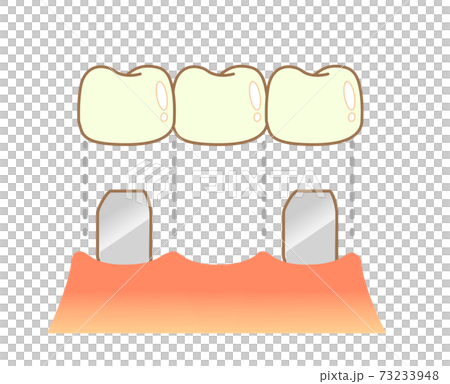 Bridge treatment Caries and progression and treatment 73233948