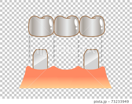 Bridge Caries and Progression and Treatment: Dental Illustration 73233949