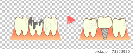 Implant Treatment Caries and Progression and Treatment 73233950