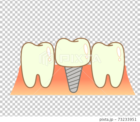 Implant Caries and Progression and Treatment: Dental Illustration 73233951