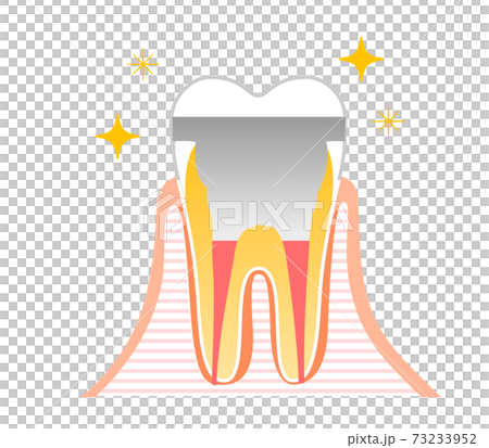 根管治療 虫歯と進行と治療:歯科のイラスト 73233952