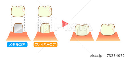 クラウン 虫歯と進行と治療 歯科のイラストのイラスト素材