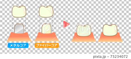 Crown Caries and Progression and Treatment: Dental Illustration 73234072