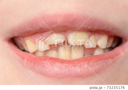 Close-up of a small boy with curved teeth smiling Close-up of a small boy with curved teeth smiling 73235176
