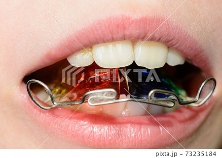 Close-up of a metal plate in the mouth on the teeth of a little boy Close-up of a metal plate in the mouth on the teeth of a little boy 73235184