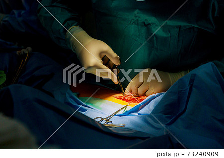 Patient with a cutting our incision a deeper human leg with bloody scar from surgery. 73240909