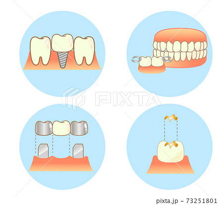 ブリッジ インプラント 入歯 インレーの違いイラストのイラスト素材
