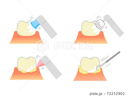 Pmtc 歯のクリーニング 歯科イラストのイラスト素材