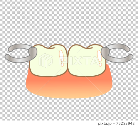 Illustration of partial dentures: illustration of dentistry 73252948