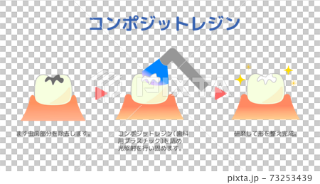 コンポジットレジンCR接着修復法のイラスト コンポジットレジンCR接着修復法のイラスト 73253439