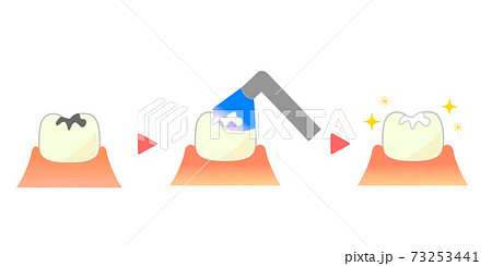 コンポジットレジンCR接着修復法のイラスト 73253441