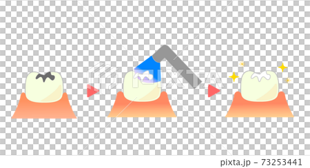 Illustration of composite resin CR adhesive restoration method 73253441