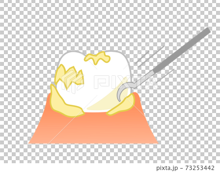 Periodontal Plaque Removal and Scaler: Dental Illustration 73253442