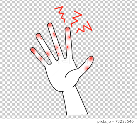 Cracks in the hands - Stock Illustration [73253540] - PIXTA