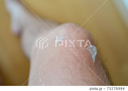日焼け後の皮むけ 73276984
