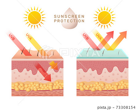 Uv skin protection. Damaged human skin peels before and after sun protection body adipose layers epidermis recent vector infographic template Uv skin protection. Damaged human skin peels before and after sun protection body adipose layers epidermis recent vector infographic template 73308154