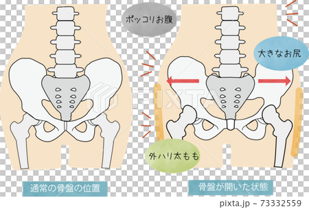 通常の骨盤部のイラストと骨盤が開いた状態を表したイラストのイラスト素材