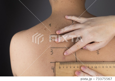 An allergist or dermatologist examines red spots on a man face. The male suffers from a rash, hives and itching. Food Allergy, Insect Bite, Measles or Chicken Pox An allergist or dermatologist examines red spots on a man face. The male suffers from a rash, hives and itching. Food Allergy, Insect Bite, Measles or Chicken Pox 73375567