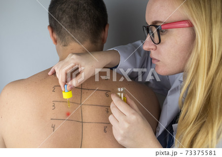 An allergist in the laboratory conducts an allergy prick-test. Skin test for household, food, epidermal allergic reactions. The test is performed on the patient back An allergist in the laboratory conducts an allergy prick-test. Skin test for household, food, epidermal allergic reactions. The test is performed on the patient back 73375581