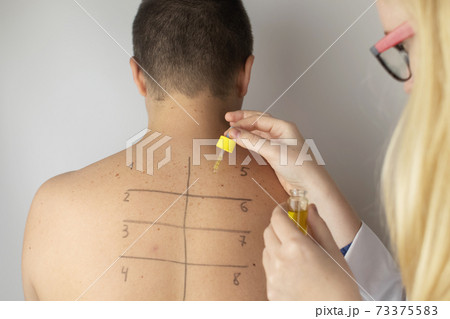 An allergist in the laboratory conducts an allergy prick-test. Skin test for household, food, epidermal allergic reactions. The test is performed on the patient back An allergist in the laboratory conducts an allergy prick-test. Skin test for household, food, epidermal allergic reactions. The test is performed on the patient back 73375583