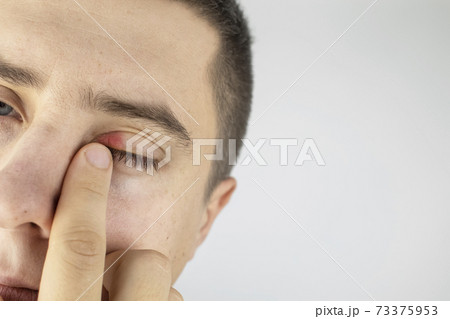 A man stands in front of a mirror and sees inflammation of the upper eyelid. Redness of the skin around the eyes and blepharitis. 73375953
