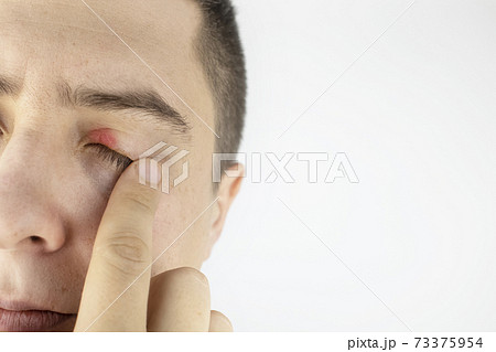 A man stands in front of a mirror and sees inflammation of the upper eyelid. Redness of the skin around the eyes and blepharitis. 73375954