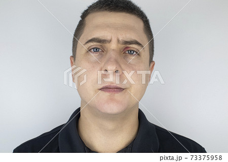 A man stands in front of a mirror and sees inflammation of the upper eyelid. Redness of the skin around the eyes and blepharitis. A man stands in front of a mirror and sees inflammation of the upper eyelid. Redness of the skin around the eyes and blepharitis. 73375958
