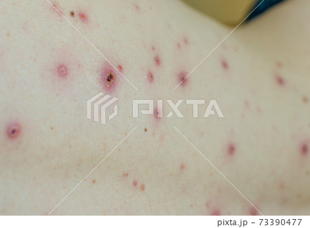 Large spots and pimples acne on the body - adult body with chickenpox. man with Chickenpox, Varicella, Varicella Zoster Virus. Large spots and pimples acne on the body - adult body with chickenpox. man with Chickenpox, Varicella, Varicella Zoster Virus. 73390477