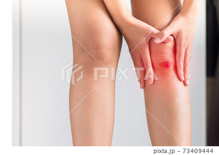 Woman suffering from bleeding wound on her knee on white background,Scab becomes Infected Woman suffering from bleeding wound on her knee on white background,Scab becomes Infected 73409444