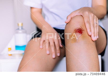 Woman using alcohol into a cotton for cleaning bleeding wound on knee,Scab becomes Infected 73409446