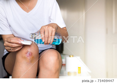 Woman pouring alcohol into a cotton for cleaning bleeding wound on knee,Scab becomes Infected 73409447