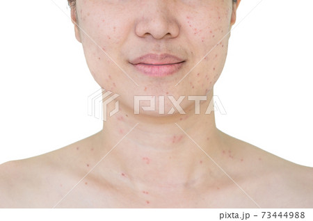 laser treatment laser treatment 73444988